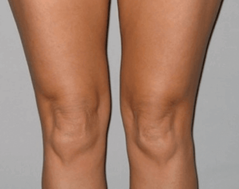 Curé la artrosis de rodilla con gel Artovitel