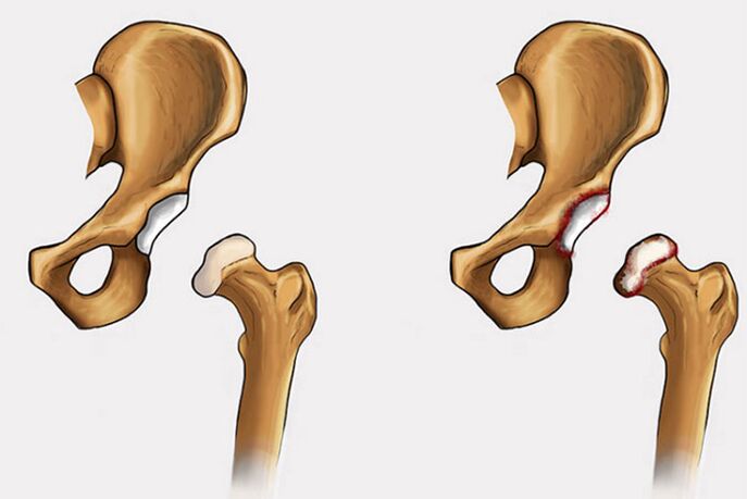 cambios degenerativos y dolor en la articulación de la cadera