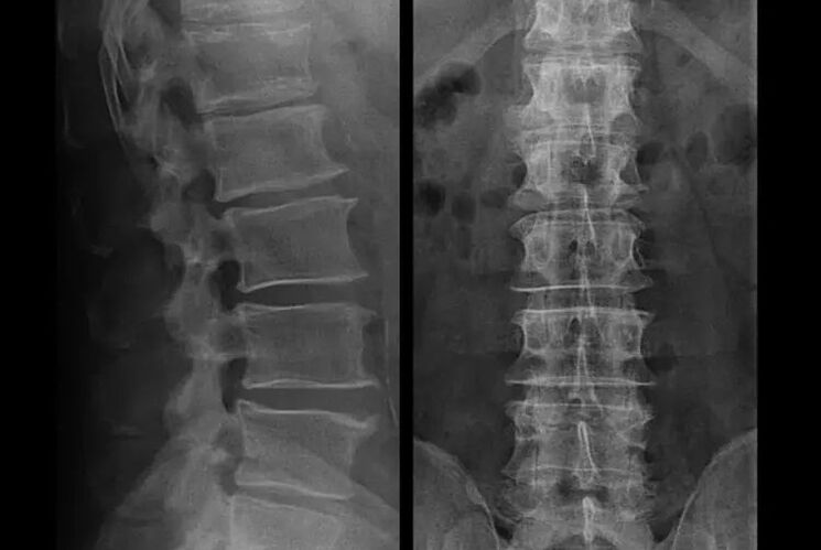 osteocondrosis en rayos x