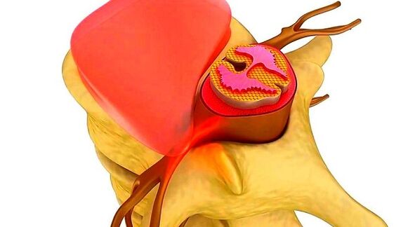 Osteocondrosis de la columna torácica La esencia de la enfermedad