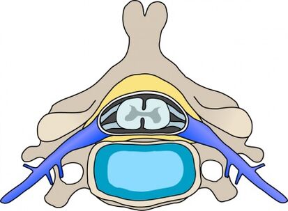 Protabio en la vértebra con osteocondrosis cervical