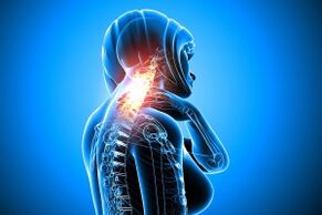 osteocondrosis en la columna cervical