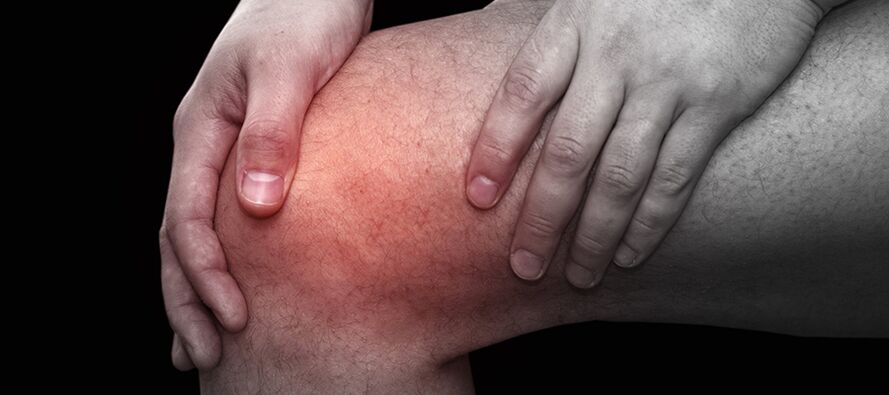 Inflamación y malestar en la rodilla con gonartrosis.